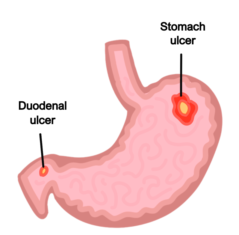 Stomach ulcer