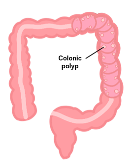 colonic polyp