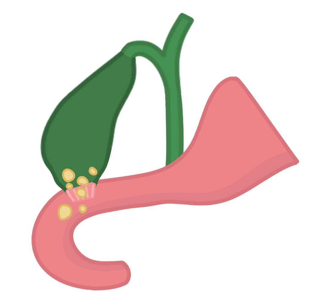 gallstone ileus