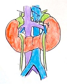 Picture 1 horseshoe kidney