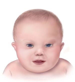 Picture 1 Down's syndrome