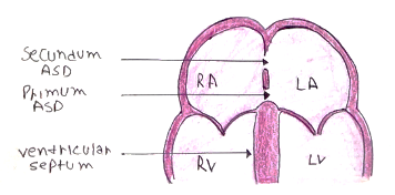 Picture 1 atrial septal defect