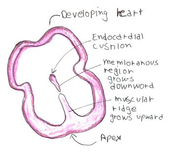 Picture 1 ventricular septal defect