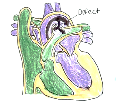 Picture 1 patent ductus arteriosus