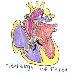 Picture 1 Tetralogy of Fallot