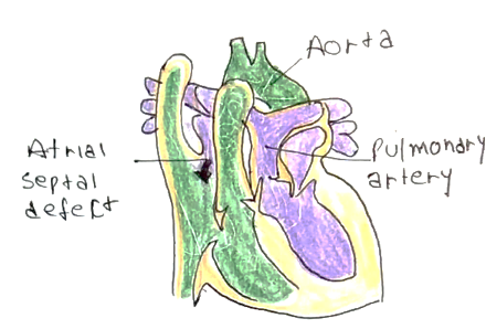 Picture 1 Transposition of great arteries