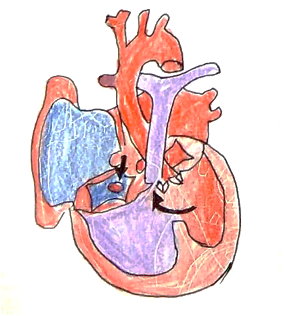 Picture 1 Atrioventricular Septal Defect