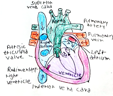 Picture 1 tricuspid atresia