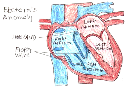 Picture 1 Ebstein's anomaly