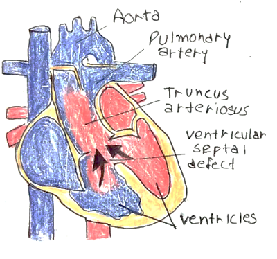 Picture 1 Persistent truncus arteriosus