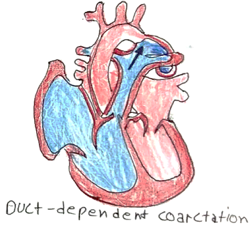 Picture 1 coarctation