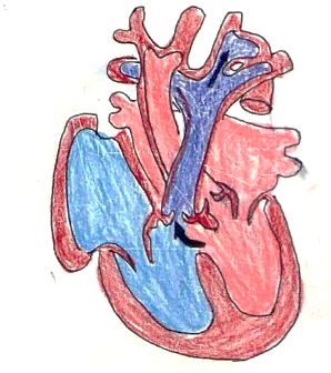 Picture 1 interruption of aortic arch