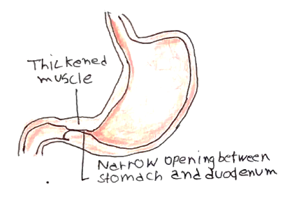 Picture 1 pyloric stenosis
