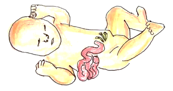 Picture 1 gastroschisis