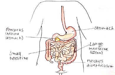 Picture 1 meckel's diverticulum