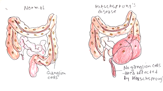 Picture 1 Hirschsprung disease