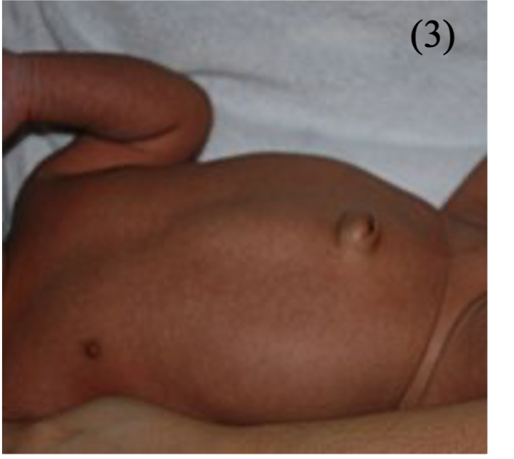 Picture 1 umbilical hernia