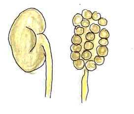 Picture 1 multicystic dysplastic kidneys
