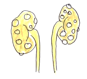 Picture 1 polycystic kidney disease