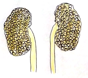 Picture 1 polycystic kidney disease
