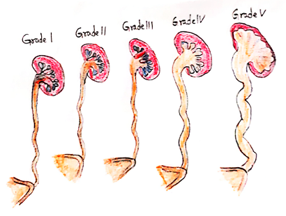 vesicoureteral reflux