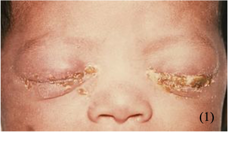 Picture 1 neonatal conjunctivitis