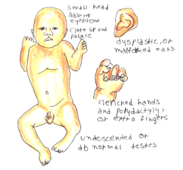 Picture 1 patau syndrome