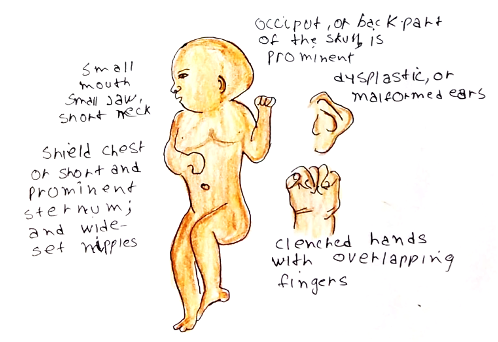 Picture 1 Edwards syndrome