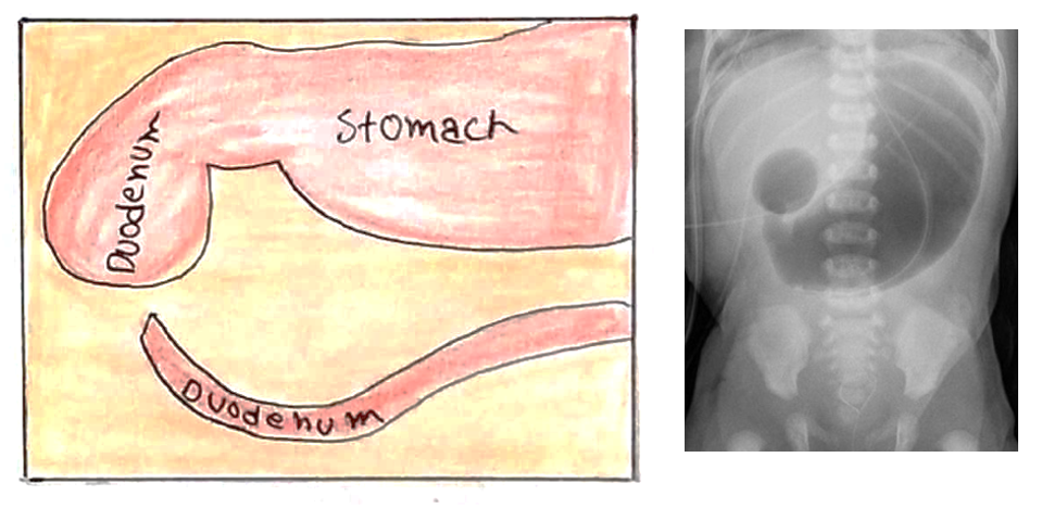 Screenshot 2021-09-07 at 13.23.05 duodenal atresia