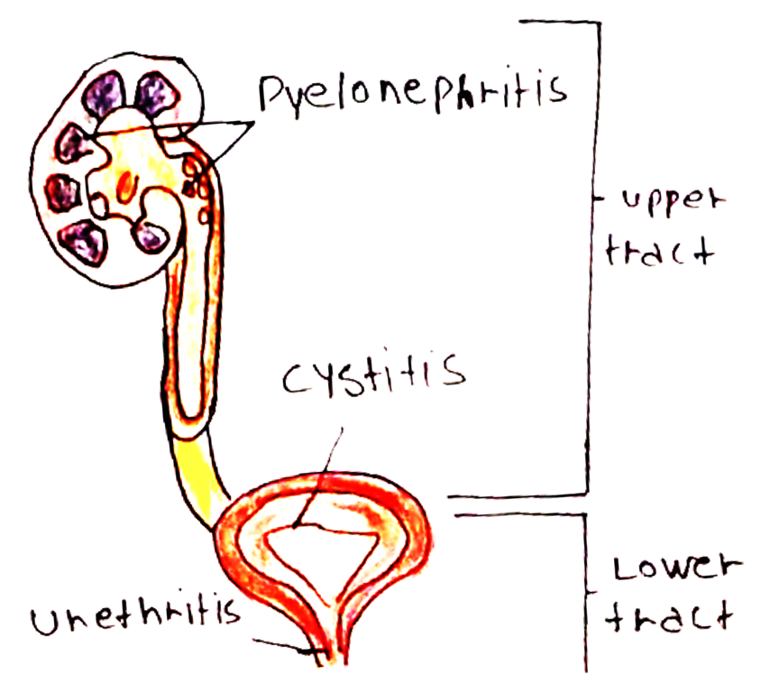 urinary tract infections