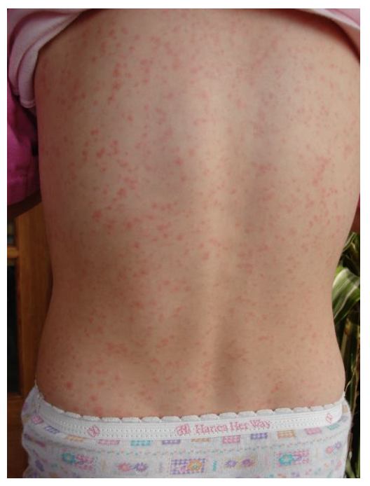 Screenshot 2021-09-07 at 19.37.29 scarlet fever