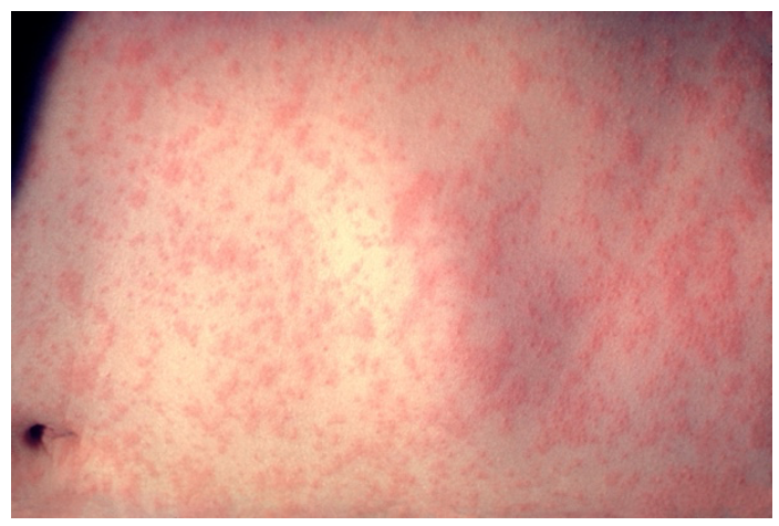 Screenshot 2021-09-07 at 19.42.44 measles