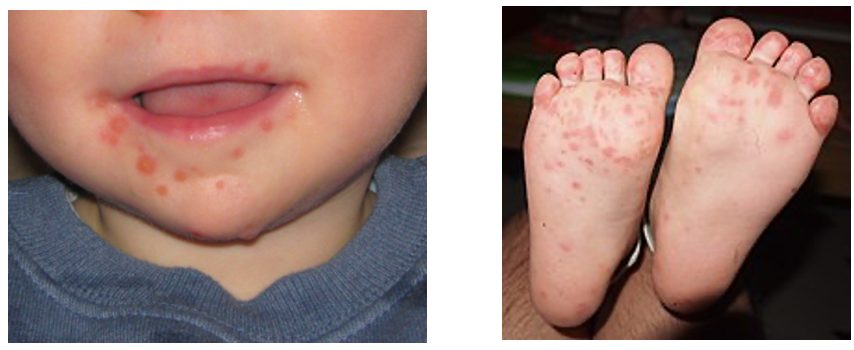 Screenshot 2021-09-07 at 19.43.01 hand foot and mouth disease