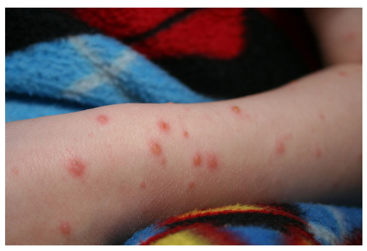 Screenshot 2021-09-07 at 19.43.12 chickenpox
