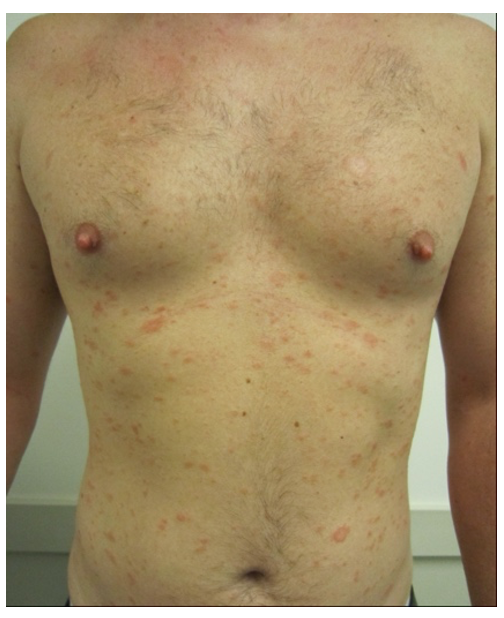 Screenshot 2021-09-07 at 19.43.18 pityriasis rosea