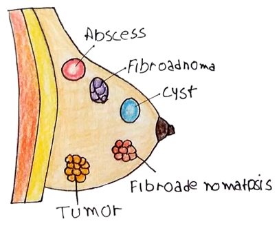 fibroadenoma