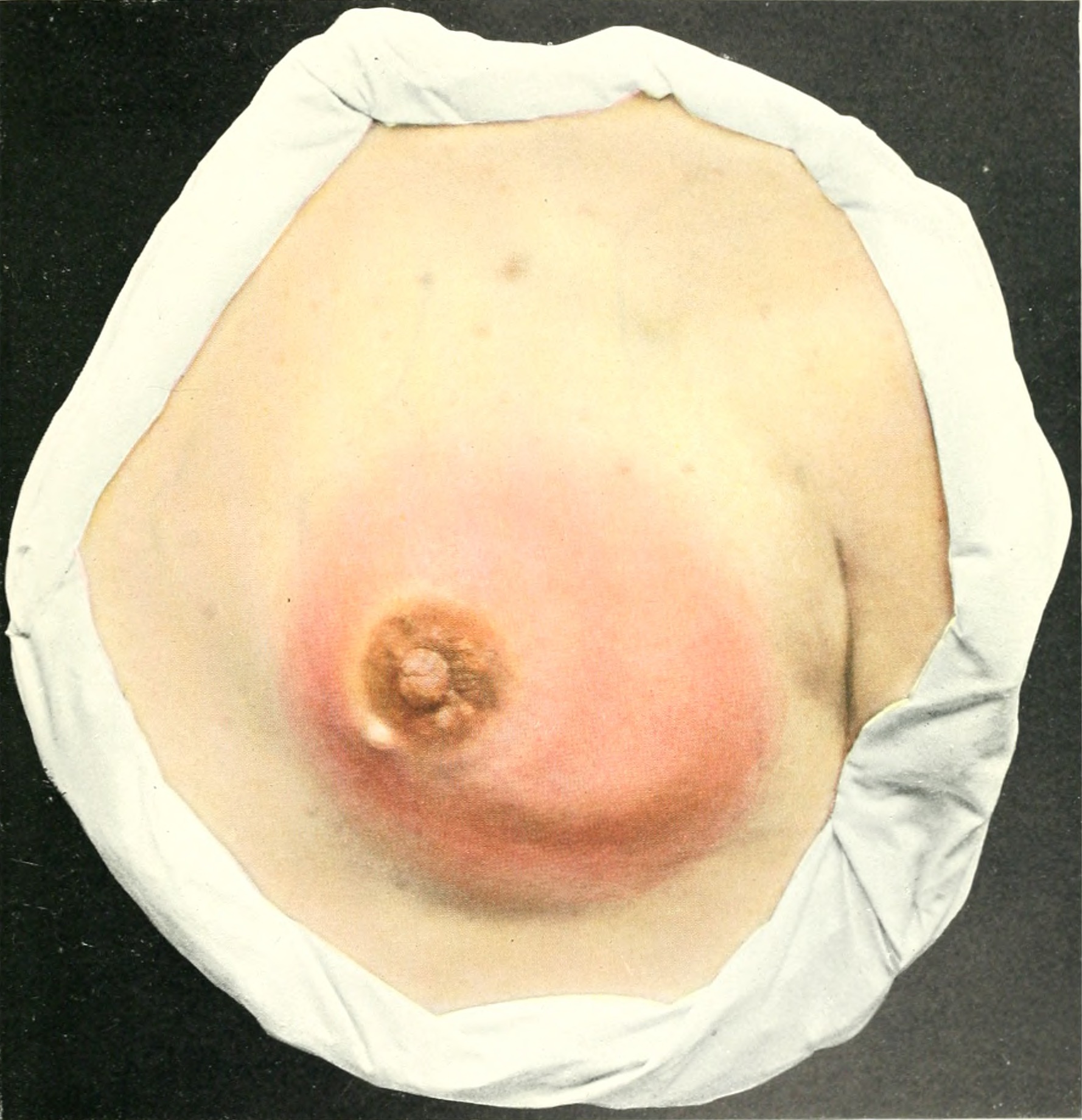 mastitis
