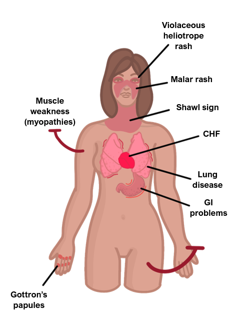 Dermatomyositis