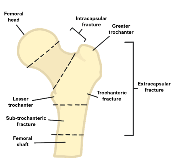 hip fractures