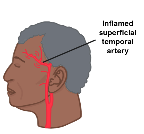 inflamed superficial temporal artery