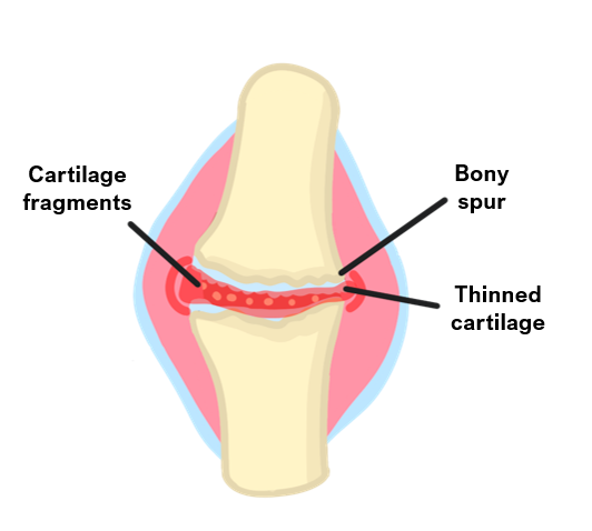 osteoarthritis