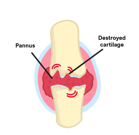 rheumatoid arthritis