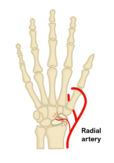 scaphoid fracture