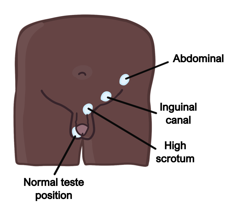 Cryptorchidism
