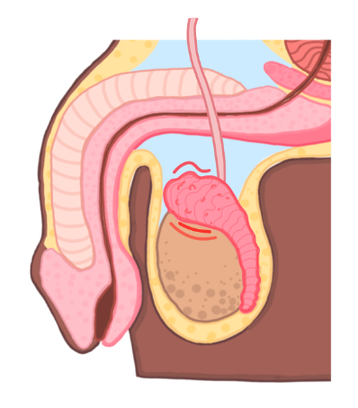 Epididymo orchitis