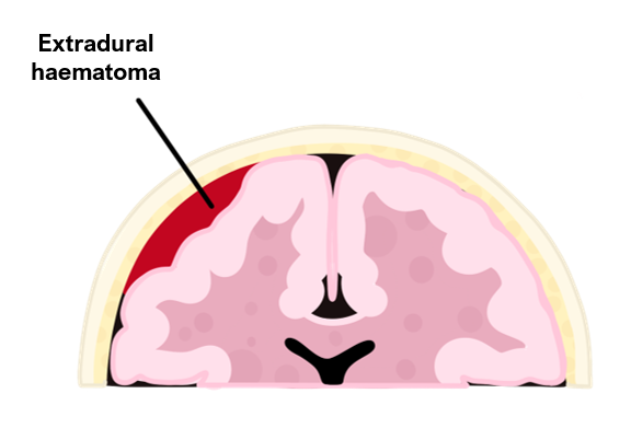 Extradural haematoma Extradural Haematoma