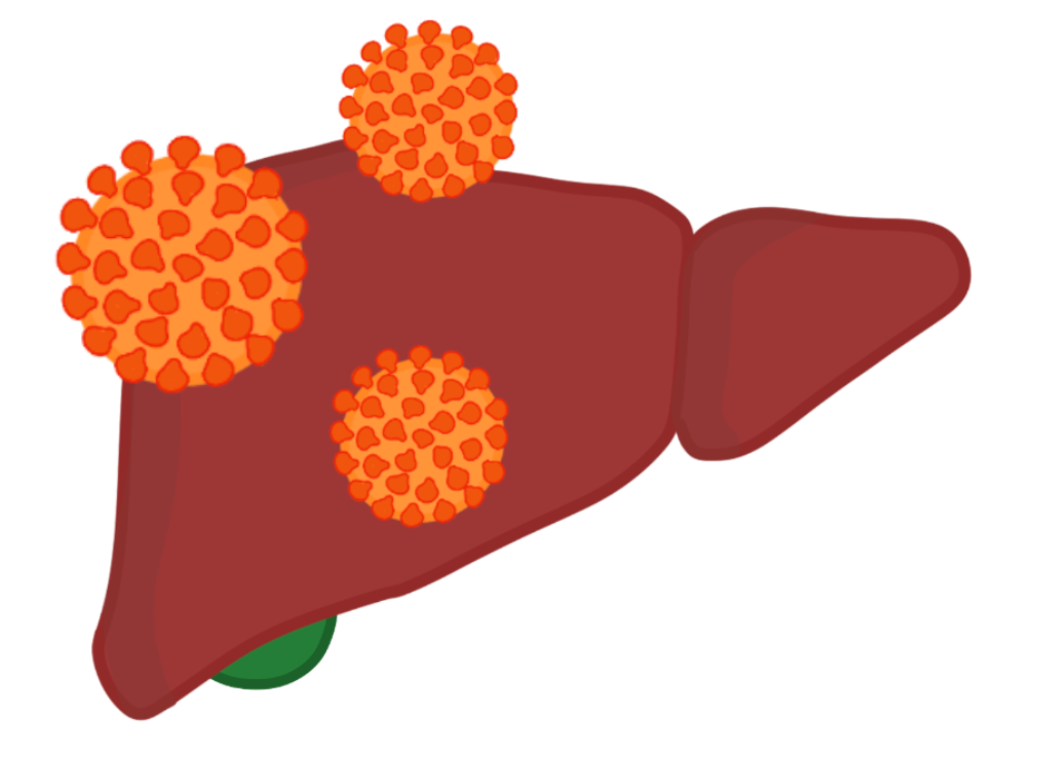 Hepatitis