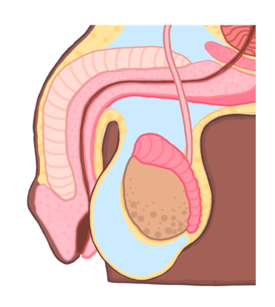 Hydrocele