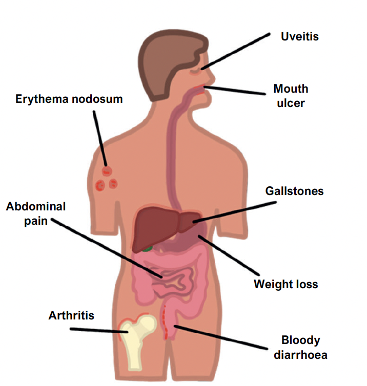 IBD symptoms