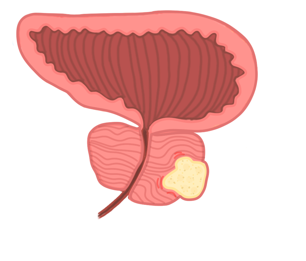 Prostate cancer